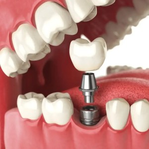 best dentist in miami,porcelain veneers miami,Botox miami,root canal cost miami,sinus lift miami,best veneers miami,best dentist south florida,best cosmetic dentist miami,best dental care miami,sage dental