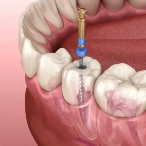 best dentist in miami,porcelain veneers miami,Botox miami,root canal cost miami,sinus lift miami,best veneers miami,best dentist south florida,best cosmetic dentist miami,best dental care miami,sage dental
