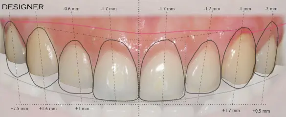 Digital smile design at Dr. G Dental Studio Miami