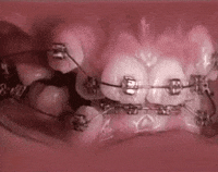 Orthodontic braces smile transformation, Dr. G Dental Studio Miami